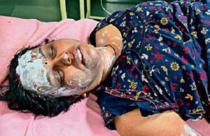 शिवपुरी में महिला टेलर ने पार्षद के घर पर पेट्रोल छिड़ककर आग लगाई, पार्षद और टेलर दोनों झुलस गए