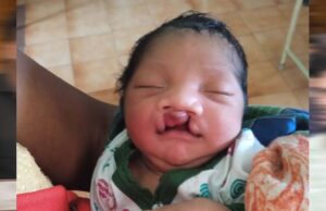 जब चिरायु टीम बनी एक परिवार की उम्मीद, जन्मजात विकृति से जूझ रहे बच्चे को मिला नया जीवन