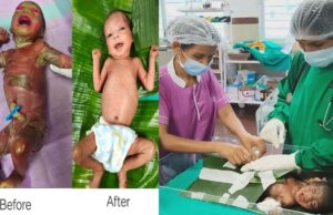 अत्यंत दुर्लभ बीमारी से जूझ रहे नवजात को बीजापुर जिला अस्पताल की SNCU में मिला नया जीवन