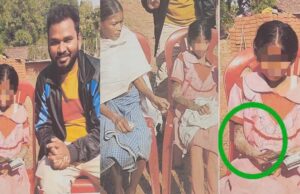 पत्थर शरीर वाली बच्ची के उपचार को लेकर बाल आयोग सक्रिय