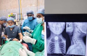 6 वर्षीय मासूम की आहार नली से सफलतापूर्वक निकाला गया सिक्का, बची जान