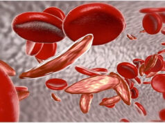 Sickle Cell Disease: देश के 59% मरीज ओडिशा और MP में मिले, 7.27 करोड़ लोगों की हुई जांच